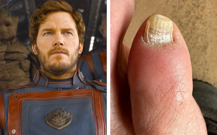 Chris Pratt, astro de 'Guardiões da Galáxia', desperta preocupações de médico após exibir unha 'podre' do pé