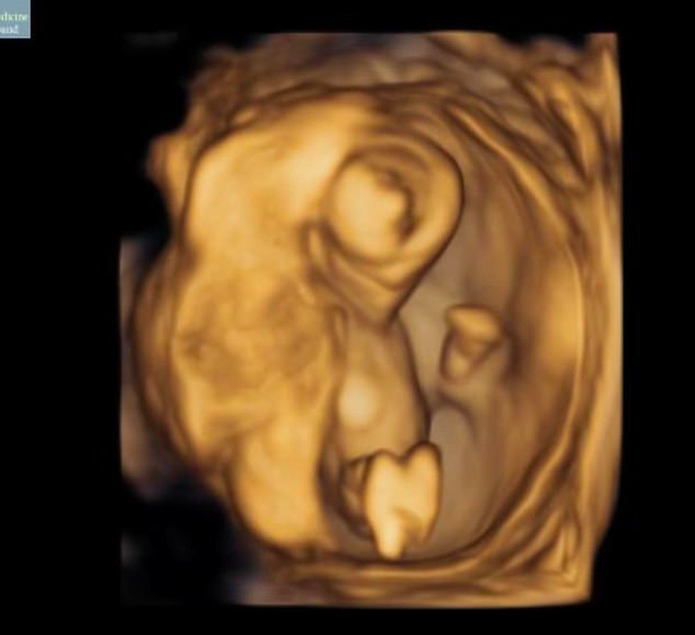 A atriz Whitney Cummings também compartilhou foto de ultrassom — Foto: Instagram