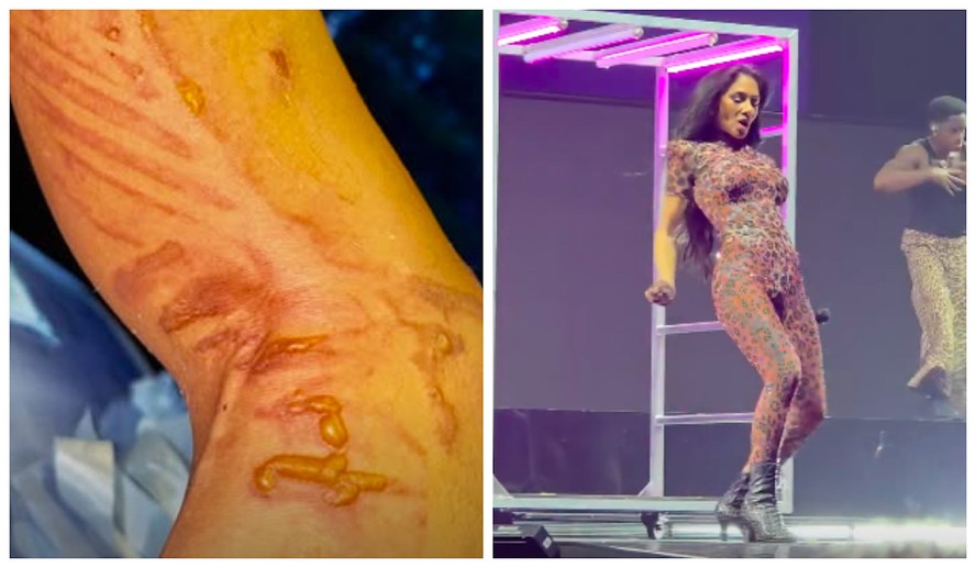 Cantora Nicole Scherzinger mostra bolhas e queimaduras após derramar água fervente na perna