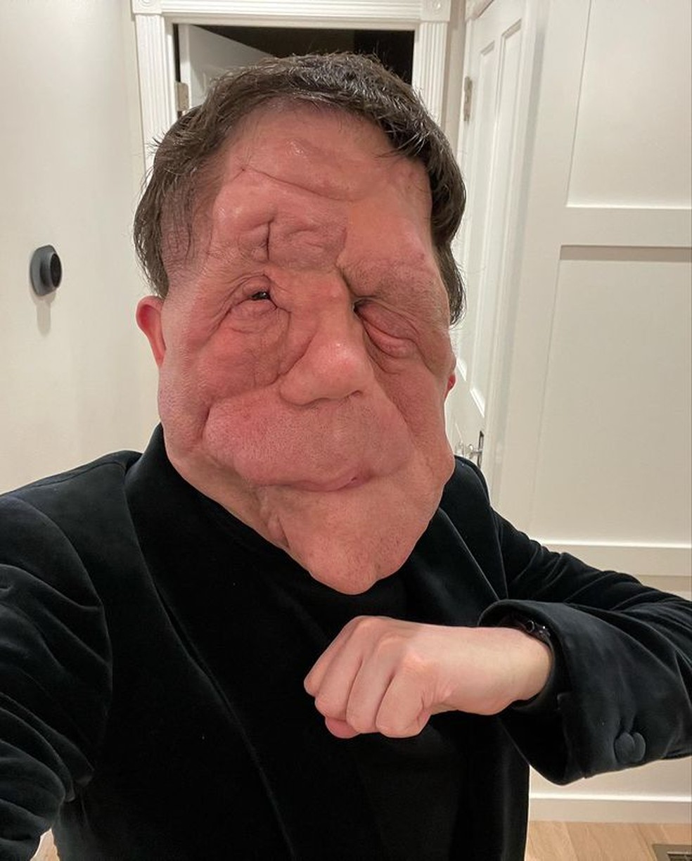 Ator com doença rara diz que 'roteiros preguiçosos' perpetuam