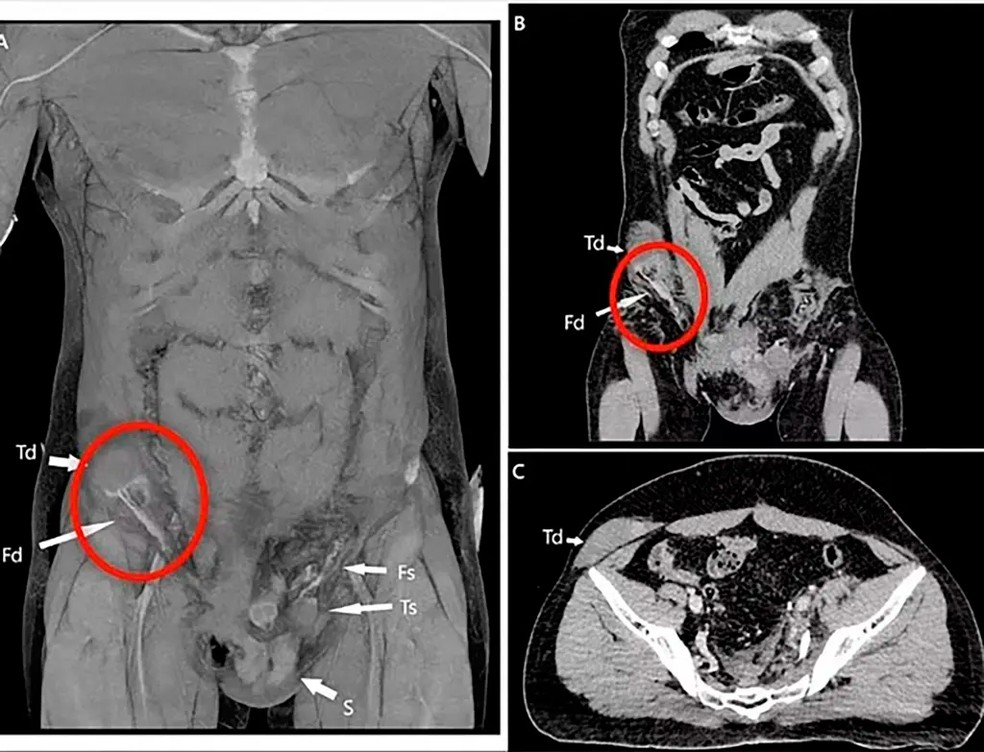 Exames mostram testítulo de italiano deslocado para dentro de seu abdômen — Foto: divulgação