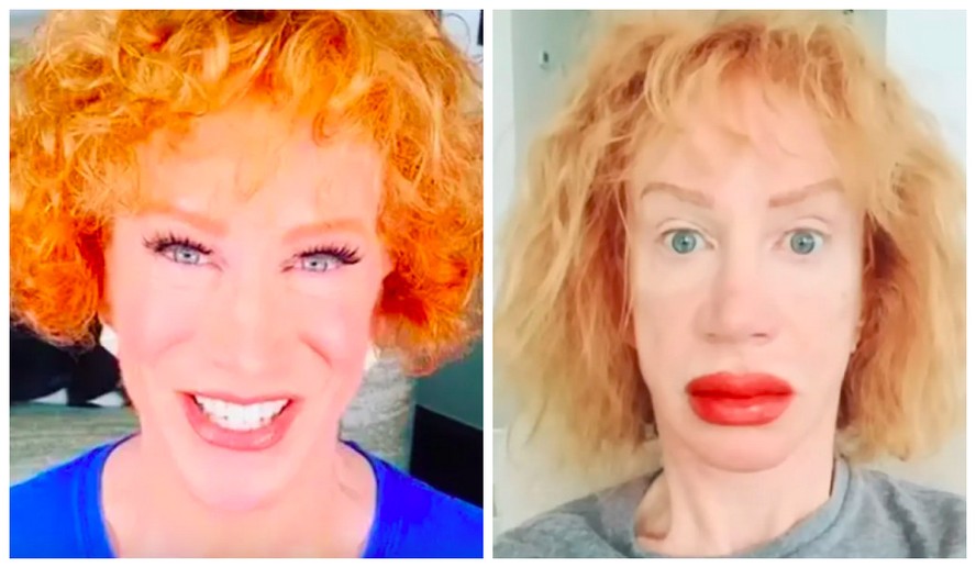 A atriz e comediante Kathy Griffin antes e depois do procedimento em seus lábios