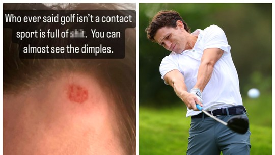 Tom Holland, astro de 'Homem-Aranha', mostra machucado após golfe com a família: 'Esporte de contato'