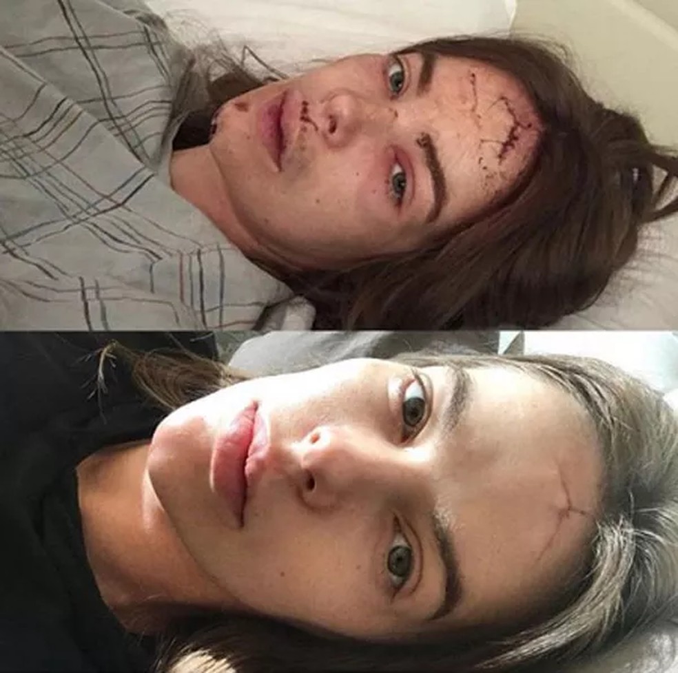 Na ocasião, Robyn Lawley postou uma imagem que mostrava seu rosto ainda com pontos e outra em que aparecia a cicatriz na testa  — Foto: Reprodução/Instagram