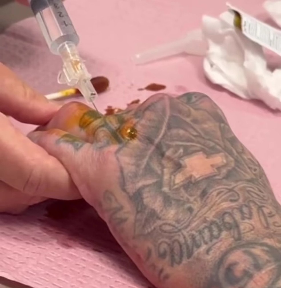 Travis Barker assusta fãs com imagens de lesão no dedo da mão — Foto: reprodução/Instagram