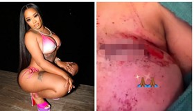 Rapper Stunna Girl diz ter levado tiro no peito e choca fãs ao postar fotos dos ferimentos