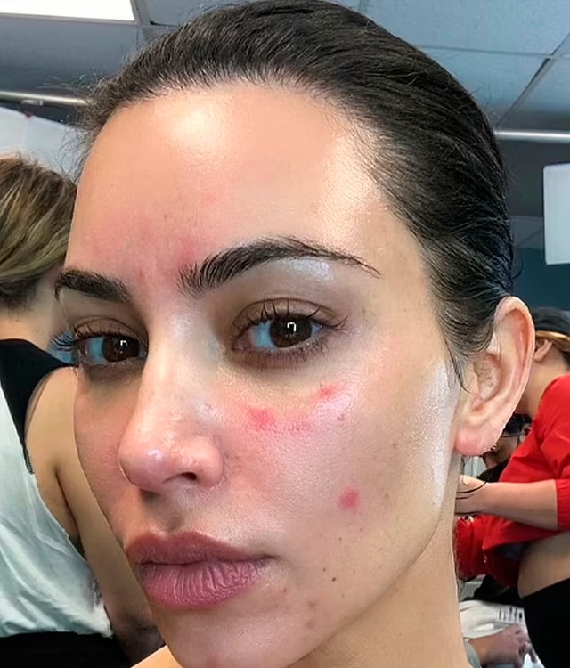 Kim Kardashian revela luta secreta contra inflamação na pele: 'Se as ...
