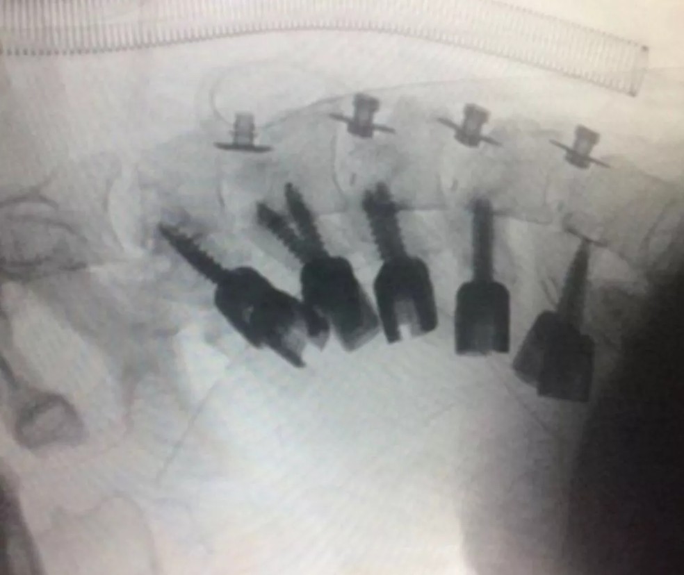 Imagem do pós-operatório de iraniano com 'Síndrome da Cabeça Caída' — Foto: divulgação