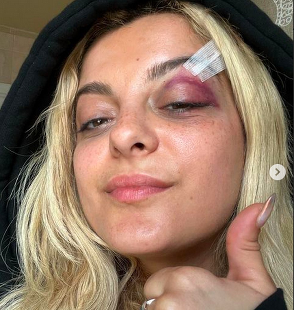 Bebe Rexha ficou com hematoma no olho e corte no supercílio após ser atingida pelo celular do fã — Foto: Instagram
