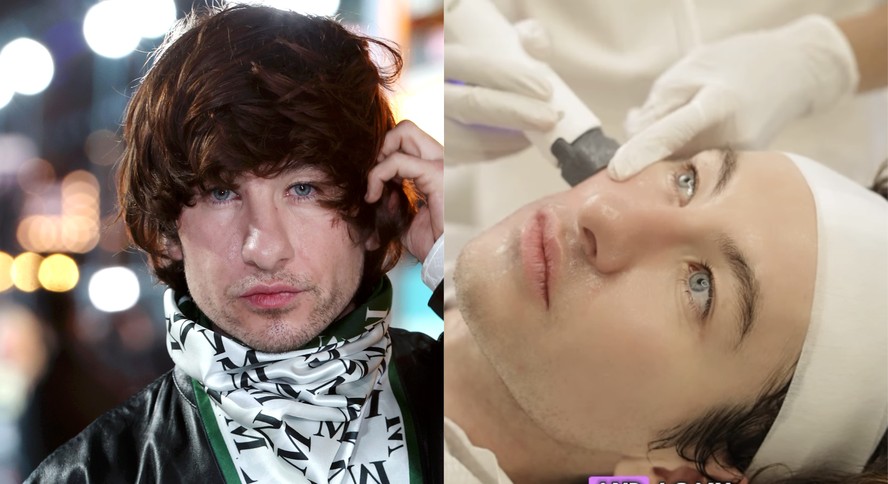 Barry Keoghan; o ator passando por procedimento estético