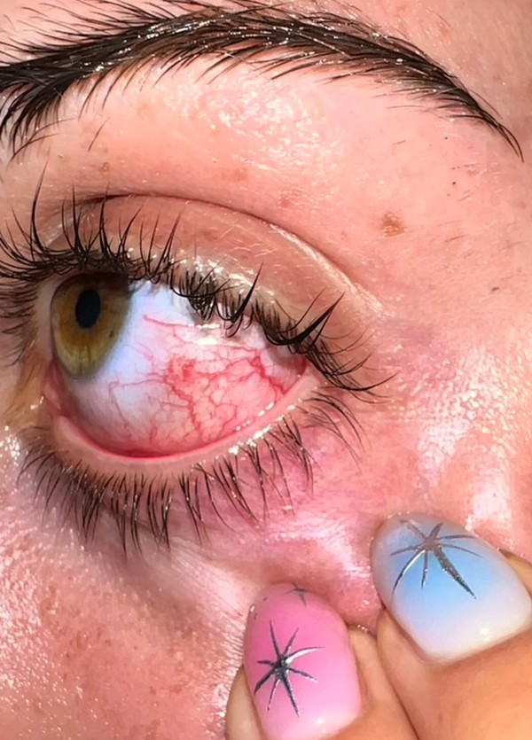 Influencer leva bicada violenta de p&aacute;ssaro dentro do olho em filmagem  agoniante e mostra les&atilde;o | Celebridades | Monet